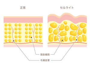 乾燥肌と温活、セルライトは冷えの原因になる。